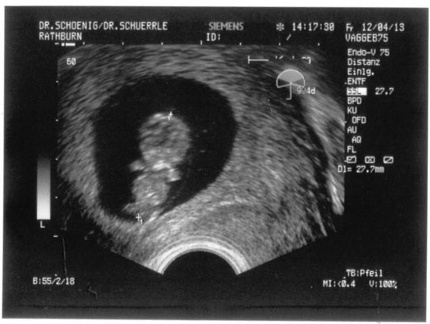 Ultrasound 12April2013a